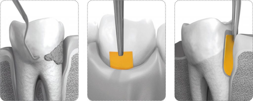 image showing how dental hygiene is done using PerioChip