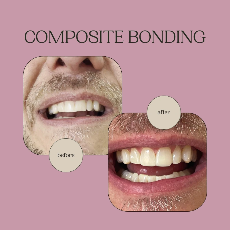 Everything You Need to Know About Dental Bonding and Composite Bonding in London - Liberty Dentists