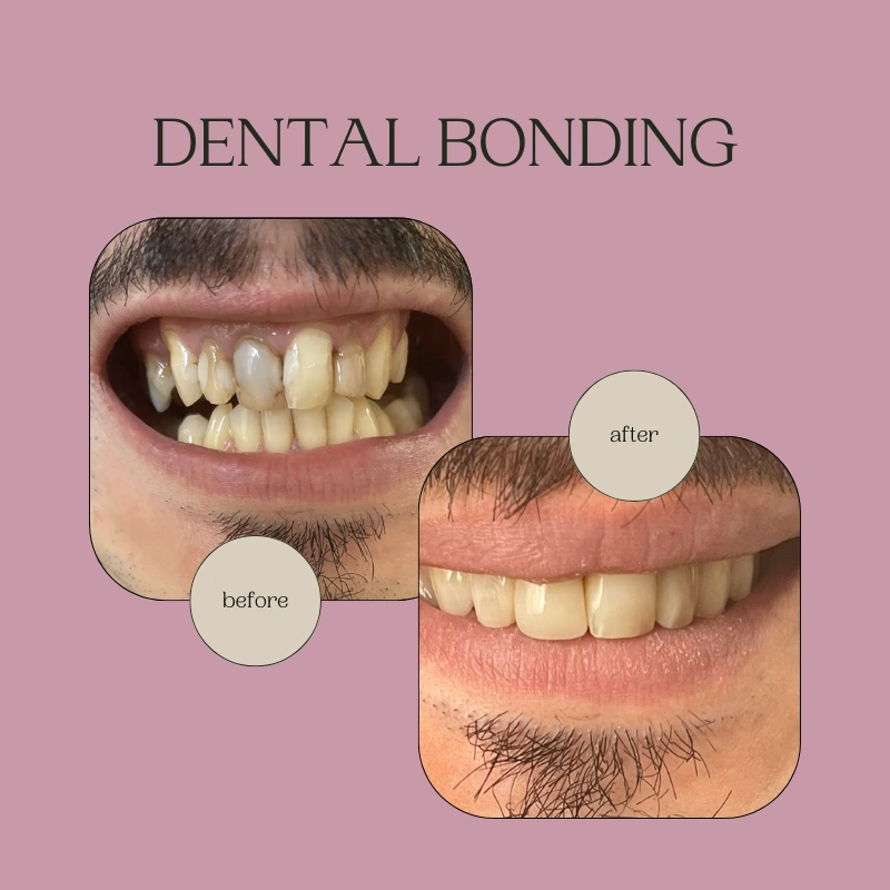 Everything You Need to Know About Dental Bonding and Composite Bonding in London - Liberty Dentists