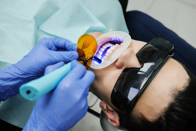 Everything You Need to Know About Dental Bonding and Composite Bonding in London - Liberty Dentists