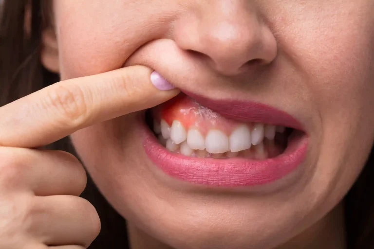 a woman showing the inside of her mouth with gum disease in London, UK - Liberty Dentists