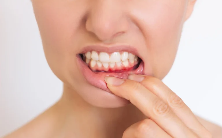 Gum Disease: Understanding, Preventing, and Treating Gum Problems - Liberty Dentists - London, UK