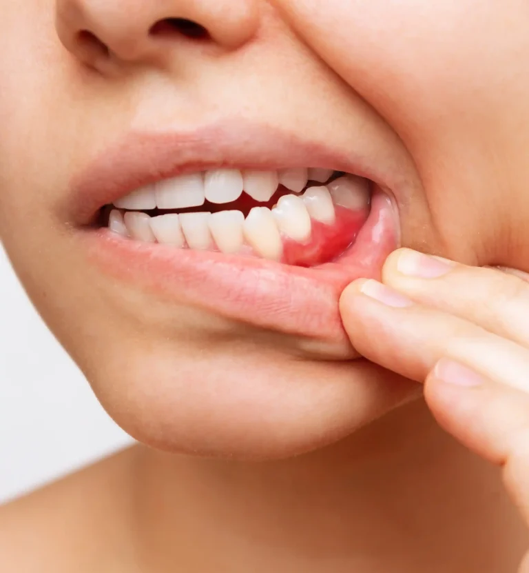 Gum Disease: Understanding, Preventing, and Treating Gum Problems - Liberty Dentists - London, UK