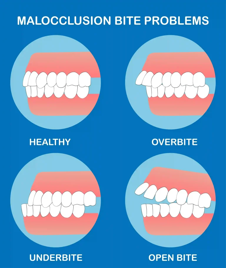 What is Malocclusion: A Guide to Know and Treat Bad or Misaligned Bite by Liberty Dentists at London, UK