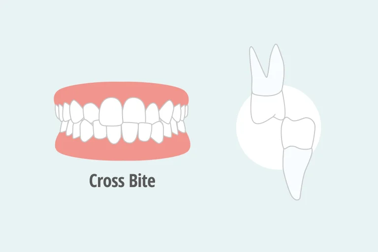 What is Malocclusion: A Guide to Know and Treat Bad or Misaligned Bite by Liberty Dentists - London, UK