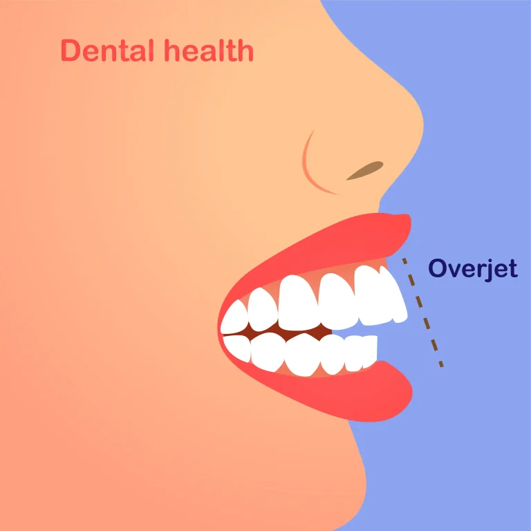 Types of Malocclusions: Overjet - Liberty Dentists, London, UK