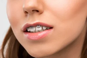 What is Malocclusion: A Guide to Know and Treat Bad or Misaligned Bite by Liberty Dentists London, UK