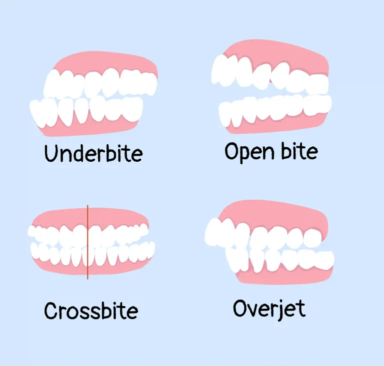 Effects of Malocclusion: A Guide by Liberty Dentists, London, UK